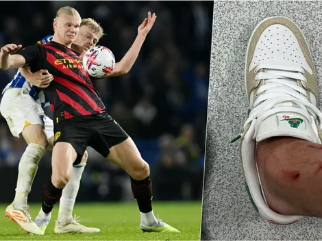 Haaland ironiza con sus marcas de guerra tras duelo con Brighton