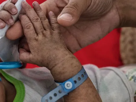 Regreso del sarampión a Chile ¿Quiénes son los grupos de riesgo?