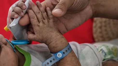 Brote de sarampión en Chile.