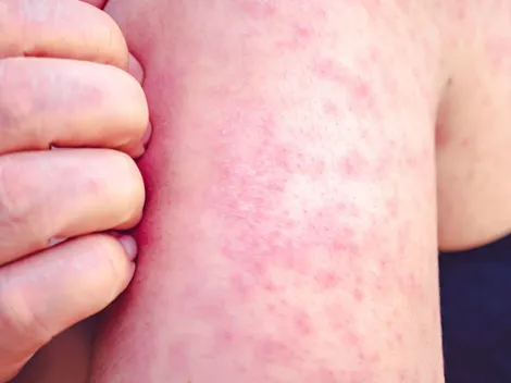 ¿Cómo se contagia el sarampión?