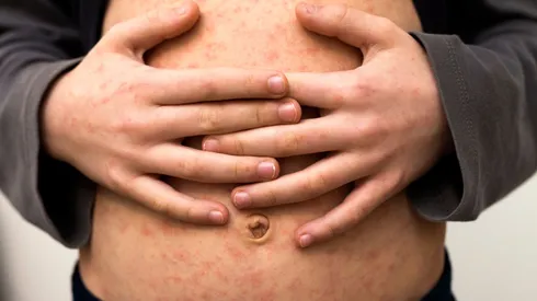 Niño con sarampión