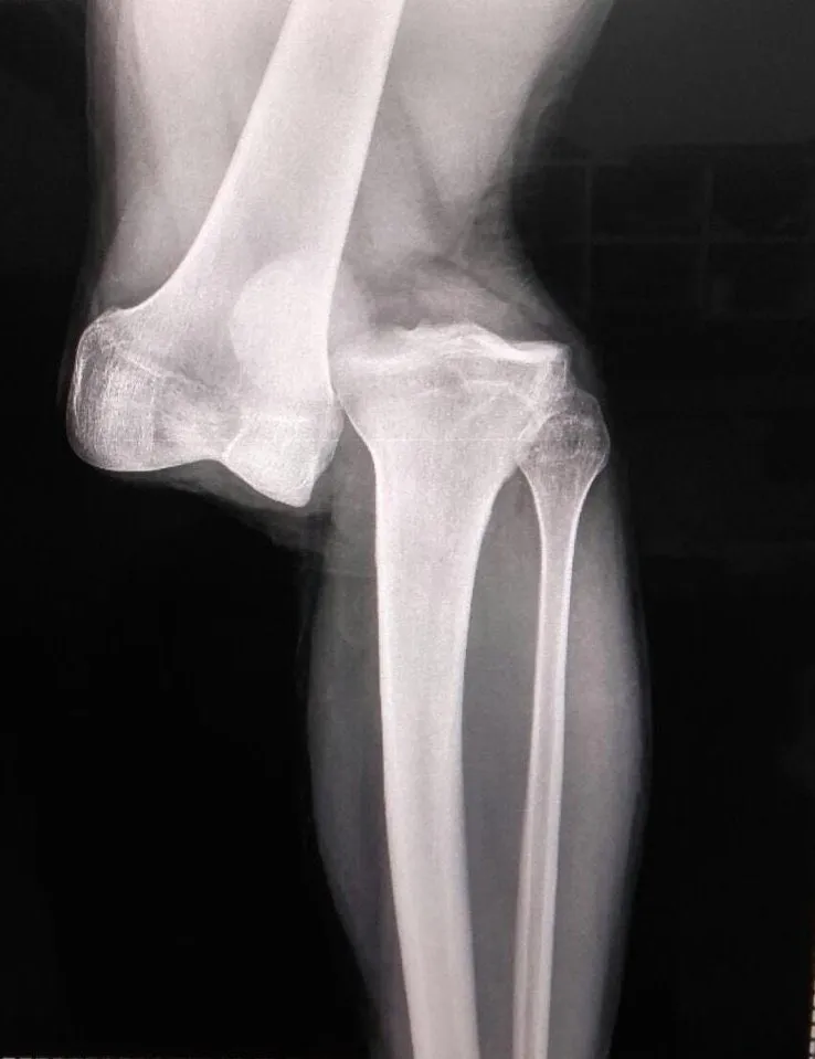 La radiografía de la grave lesión de Luciano Sánchez. | Foto: Archivo.