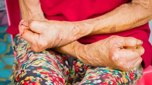 ¿Cuáles son los síntomas de la lepra? Alerta por varios casos en EEUU.