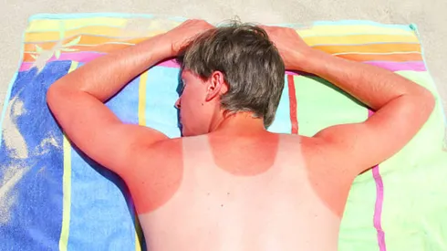 ¿Cómo cuidarse de las quemaduras solares?