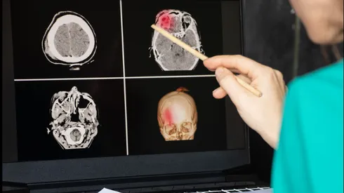 ¿Cómo prevenir un infarto cerebrovascular? Alerta de un ACV