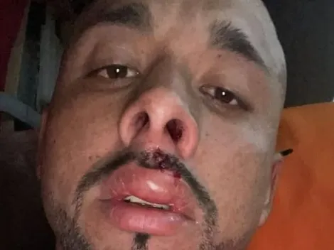 Cerezo muestra su labio ultra hinchado: "Los árbitros son un desastre"