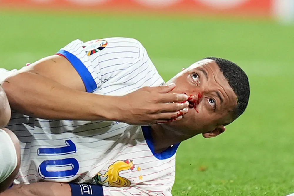 Mbappé no se baja de Francia por la fractura nasal y jugará el resto de la Eurocopa con máscara. ¡Pónganle una morada a Donatello!