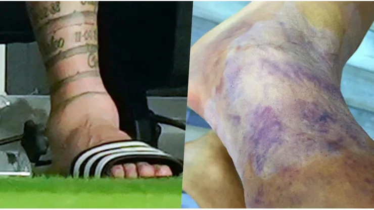 El tobillo de Lionel Messi vs el de Alexis Sánchez.