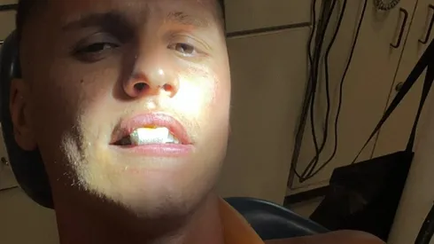 Así quedó Guido Carrillo tras perder tres dientes por un codazo de Javier Toledo en el empate 1-1 entre Estudiantes de La Plata y Sarmiento de Junín.