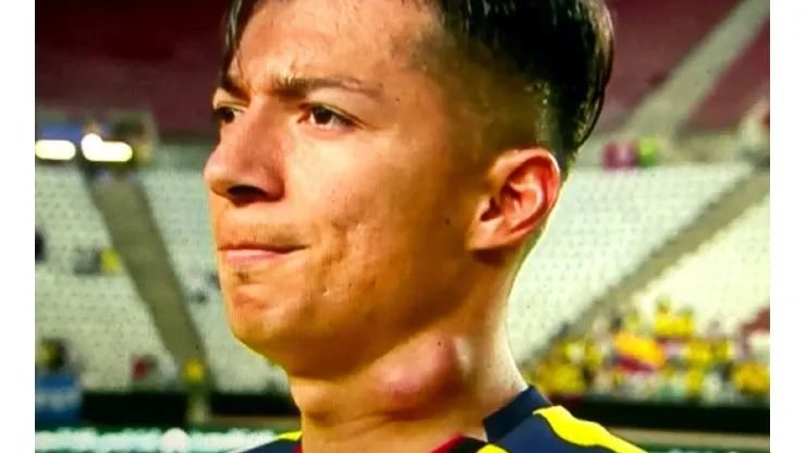 Así se vio el cuello de Alan Franco, quien salió lesionado por una molestia de isquiotibial en el amistoso frente a Arabia Saudita.