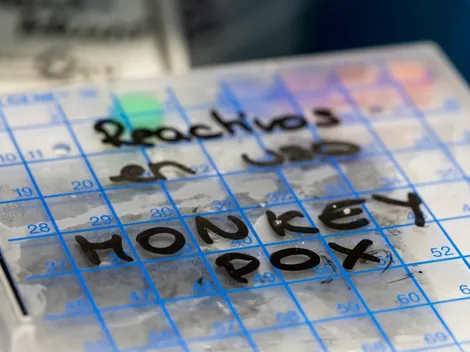 ¿Cuáles son los síntomas más comunes de la Viruela del Mono y cómo se contagia?