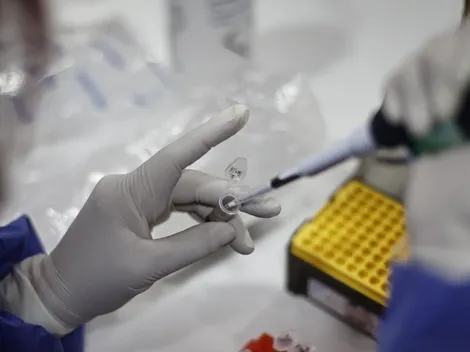 Minsal reporta 730 casos de viruela del mono en Chile