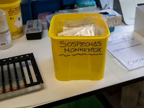 ¿Cómo se contagia y qué es la Viruela del Mono?