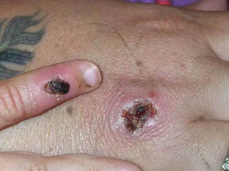 ¿Cuántos casos de la Viruela del Mono informaron hoy en Chile?