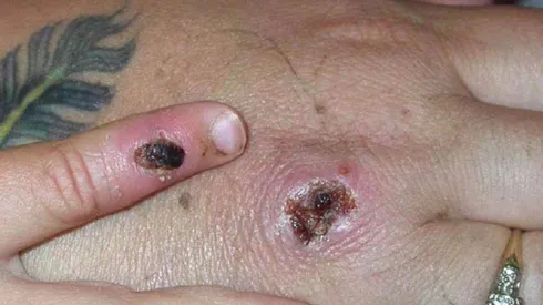 ¿Cuántos casos de la Viruela del Mono informaron hoy en Chile?