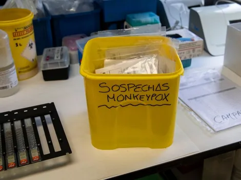 ¿Cómo se contagia la Viruela del Mono? Sus síntomas y qué hacer en casos de sospecha