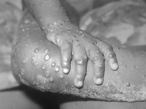 Viruela del mono: contagios han aumentado un 77% en la última semana