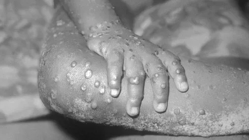 Viruela del mono: contagios han aumentado un 77% en la última semana