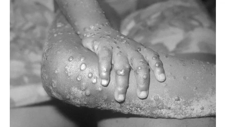 Viruela del mono: contagios han aumentado un 77% en la última semana