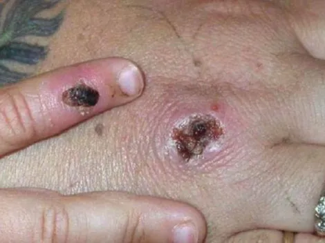 OMS descarta Emergencia Internacional por viruela del mono