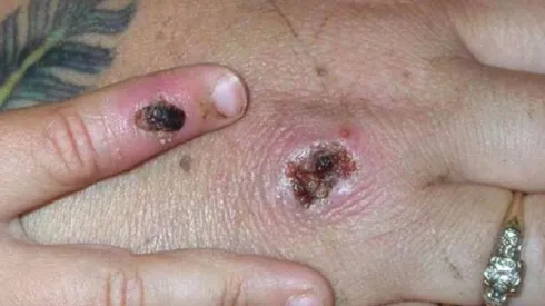 OMS descarta Emergencia Internacional por viruela del mono