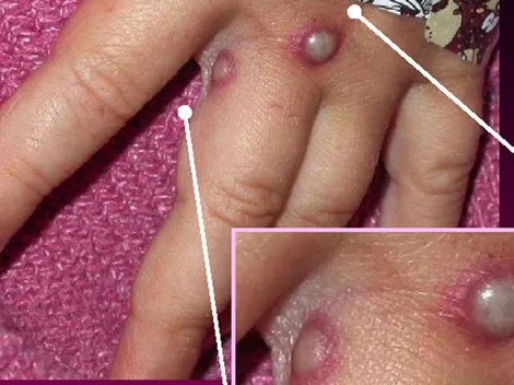 OMS se reúne para definir si cataloga la viruela del mono como Emergencia Internacional