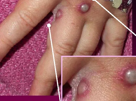 ¿Cómo se contagia la Viruela del Mono y cómo protegerse?