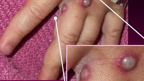 ¿Cómo se contagia la Viruela del Mono y cómo protegerse?