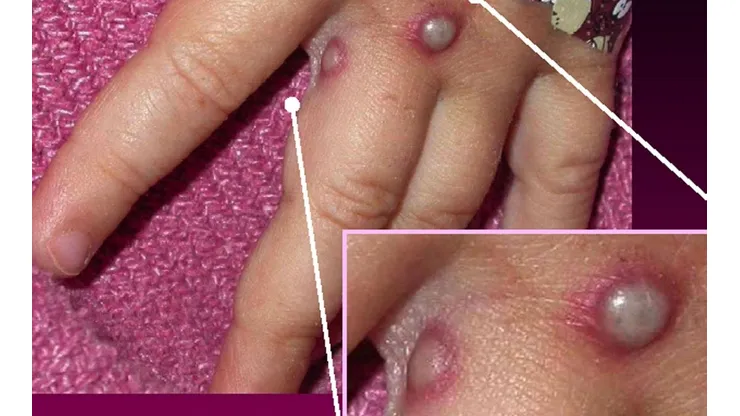 ¿Cómo se contagia la Viruela del Mono y cómo protegerse?