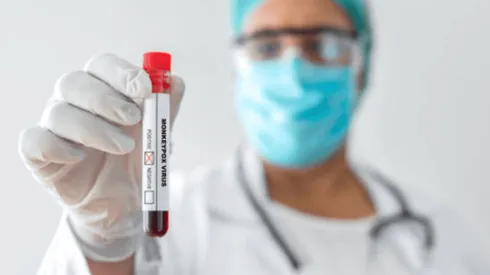 ¿Cómo prevenir la viruela del mono?