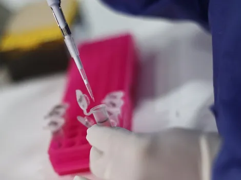 ¡Segundo caso de Viruela del Mono en Chile! Minsal confirma enfermo en La Araucanía