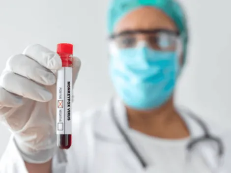 ¿Cuál es el origen de la Viruela del Mono?