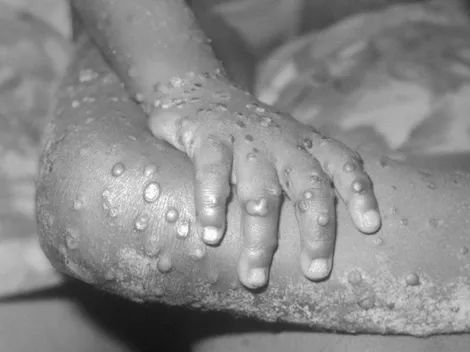 ¿En qué países se han detectado casos de la Viruela del Mono?