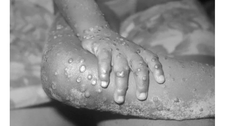¿En qué países se han detectado casos de la Viruela del Mono?