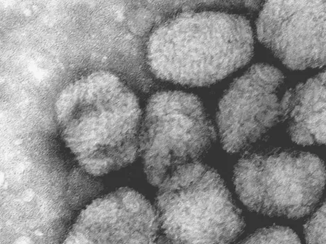 Venezuela detecta su primer caso de Viruela del Mono