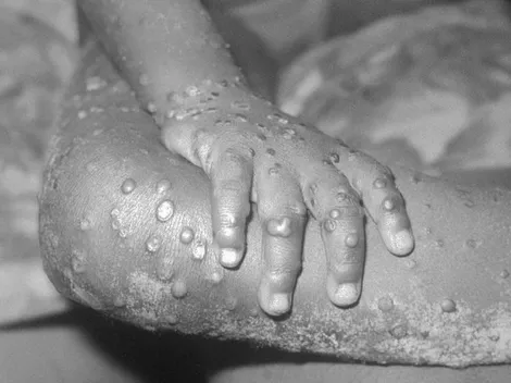 Uruguay y Costa Rica informaron casos sospechosos de viruela del mono