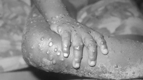 Uruguay y Costa Rica informaron casos sospechosos de viruela del mono