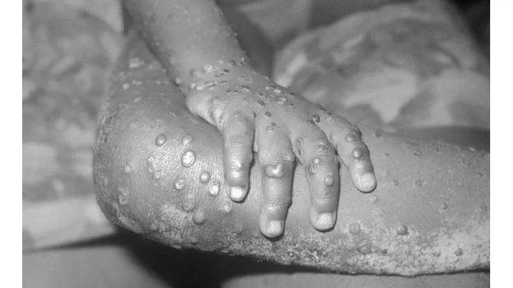 Uruguay y Costa Rica informaron casos sospechosos de viruela del mono
