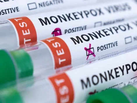 Viruela del Mono | ¿Hay casos en Chile y cómo se detectan?