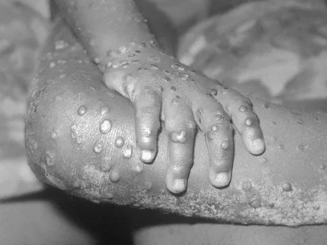 OMS: es "poco probable" que viruela del mono se convierta en pandemia