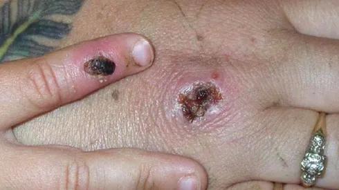 La viruela del mono sigue expandiéndose por el mundo.