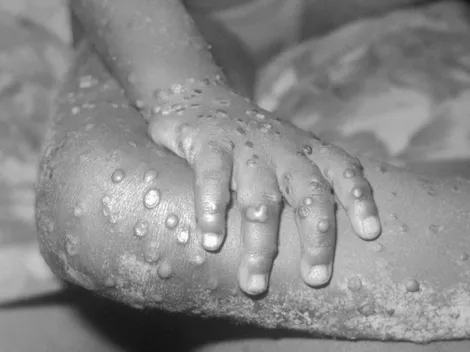 ¿De dónde viene la viruela del mono y cuándo empezó?