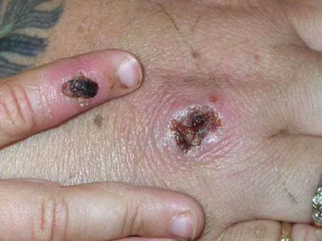 Viruela del mono | ¿Puede convertirse en pandemia como el Covid-19?
