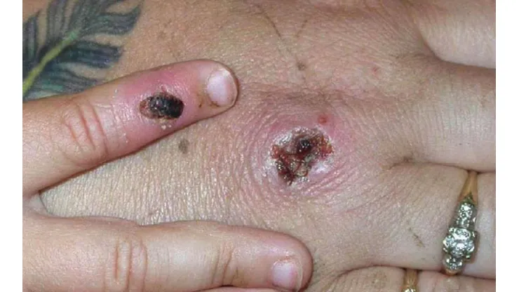 Viruela del mono | ¿Puede convertirse en pandemia como el Covid-19?