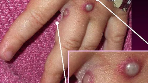 Ministerio de Salud envía alerta epidemiológica a Seremis de Salud por Viruela del Mono