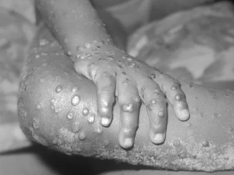 ¿Cómo se contagia la Viruela del Mono y existe un tratamiento o vacuna?