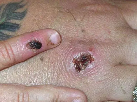 Viruela del mono: Argentina detectó primer caso sospechoso de la enfermedad