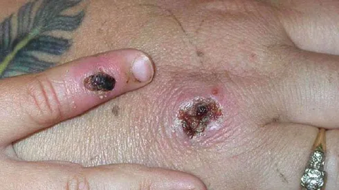 Viruela del mono: Argentina detectó primer caso sospechoso de la enfermedad