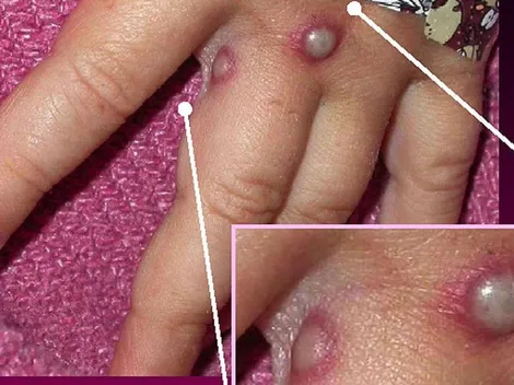 OMS convoca reunión de emergencia por propagación de viruela del mono