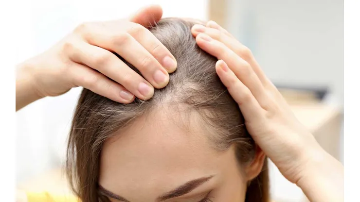 ¿De qué se trata la Alopecia y cuáles son los tratamientos?